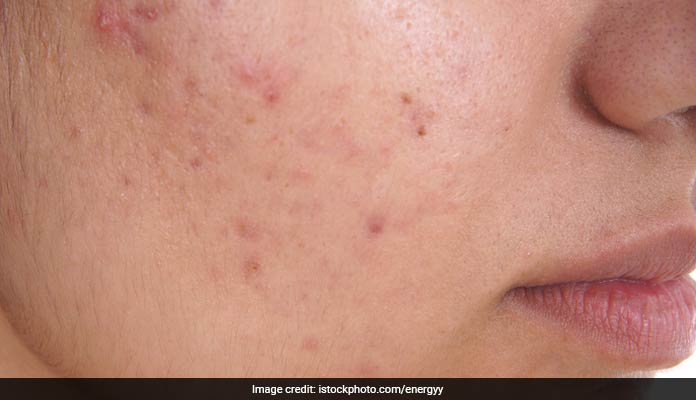 How To Get Rid Of Acne Blemishes Naturally