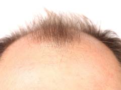 6 Things You Should Know About Hair Transplants