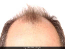 Yoga For Hair : सिर्फ यह योग करने से दूर हो जाएगी गंजेपन की समस्या, बालों का झड़ना और असमय सफेद होना होगा कम Yoga For Hair : सिर्फ यह योग करने से दूर हो जाएगी गंजेपन की समस्या, बालों का झड़ना और असमय सफेद होना होगा कम