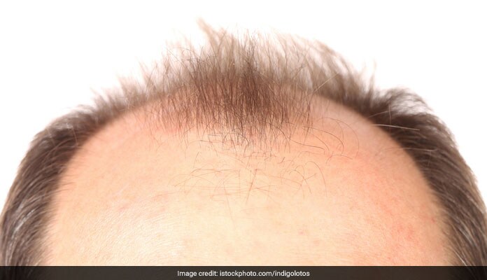 6 Things You Should Know About Hair Transplants