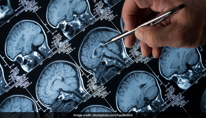 Gigantic Egg Shaped Cyst Removed From A Woman's Brain