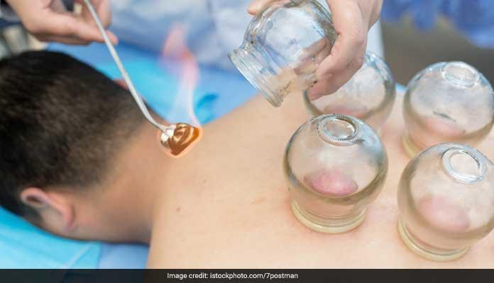 Chinese Cupping Therapy Can Help Your Sore Muscles