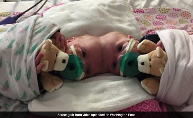 Doctors Just Separated Twin Girls Joined At The Head In One Of The World's Rarest Surgeries