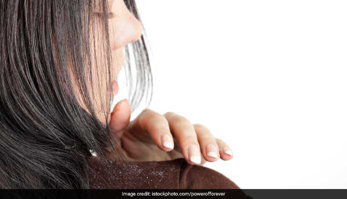 Dandruff? Try These Most Effective Natural Remedies