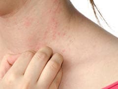 7 Self Care Tips For People With Eczema
