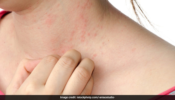 Now Treat Your Eczema With This New Unusual Approach
