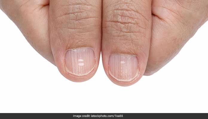 A Look At Your Nails Can Tell If You Have A Life Threatening Disease!
