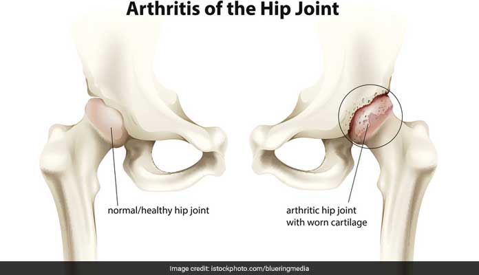 osteoarthritis