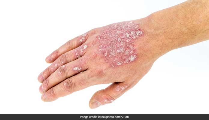 Psoriasis And Mental Health: How Chronic Skin Conditions Affect Psychological Well-Being