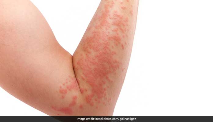 skin rashes