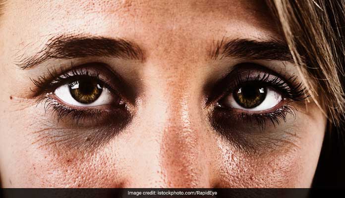 Dark Circles: आंखों के नीचे नजर आने लगे हैं काले घेरे तो खीरे में मिलाकर लगा लें ये एक चीज, ग्लो करने लगेगी स्किन Dark Circles: आंखों के नीचे नजर आने लगे हैं काले घेरे तो खीरे में मिलाकर लगा लें ये एक चीज, ग्लो करने लगेगी स्किन