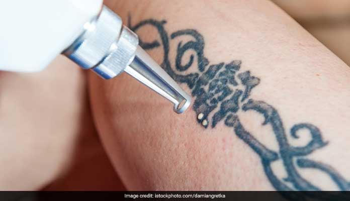 Tattoo Removal  Dr Maha Marji