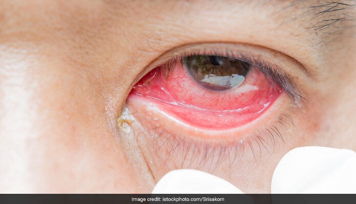 क्या है Eye Worm और आखों के लिए कितना खतरनाक? दिखें अगर ये लक्षण तो हो जाएं सावधान क्या है Eye Worm और आखों के लिए कितना खतरनाक? दिखें अगर ये लक्षण तो हो जाएं सावधान