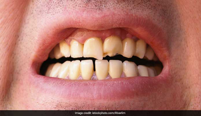 How To Get Rid Of Yellow Teeth: रातों-रात पीले दांतों को सफेद करने के 5 आसान और प्राकृतिक तरीके