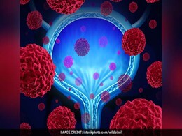 New Molecular Test Can Predict Death Risks In Breast Cancer Patients New Molecular Test Can Predict Death Risks In Breast Cancer Patients