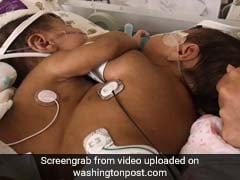 How Doctors Used Virtual Reality To Save The Lives Of Conjoined Twin Sisters