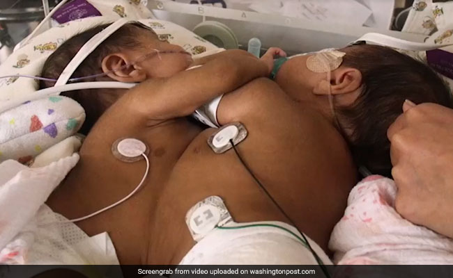 How Doctors Used Virtual Reality To Save The Lives Of Conjoined Twin Sisters