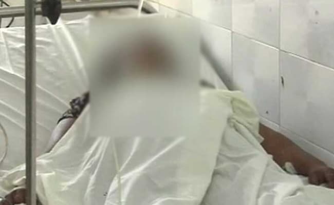 Fourth Acid Attack On UP Rape Survivor, Chief Minister Yogi Adityanath's Conspiracy Theory