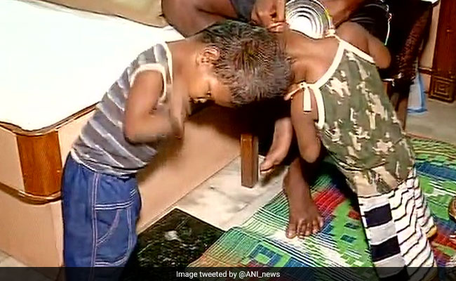 AIIMS Doctors To Try Separating Twins Joined At The Head