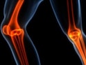 Discovery: Arthritis Could Be The Reason We Survived Ice Age
