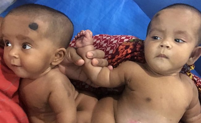 Bangladesh Performs 'First' Conjoined Twin Surgery