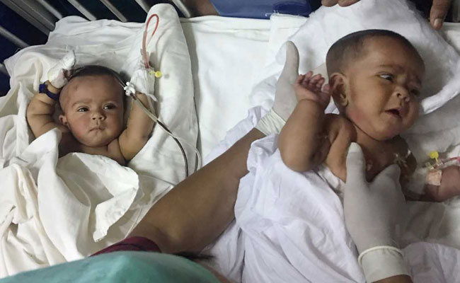 conjoined twins bangladesh afp