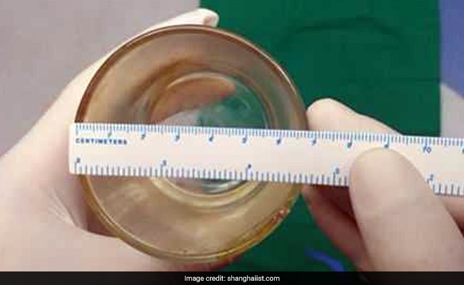 Doctors Find Glass Cup Inside Man's Body... In The Most Unexpected Place