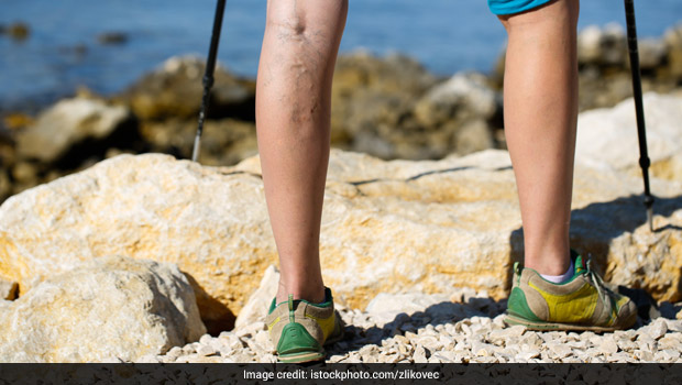 5 Home Remedies for Deep Vein Thrombosis (DVT) and Natural Treatment