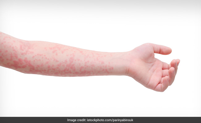 Red Dots On The Skin: Causes And Remedies