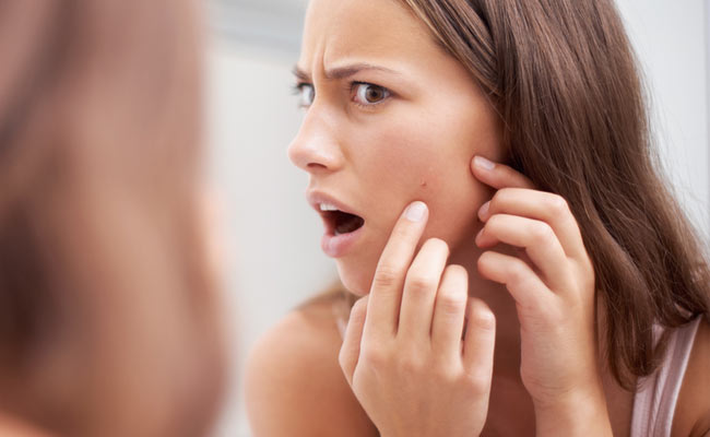 Clear Skin Isn't Always One Of Adulthood's Privileges