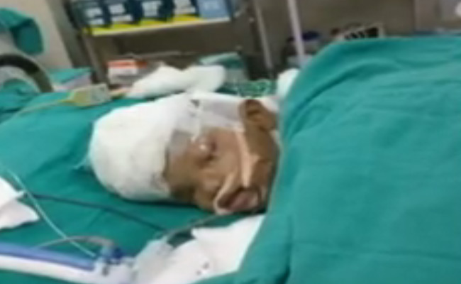 सिर से जुड़े जुड़वा बच्चों की स्थिति स्थिर: एम्स डॉक्टर