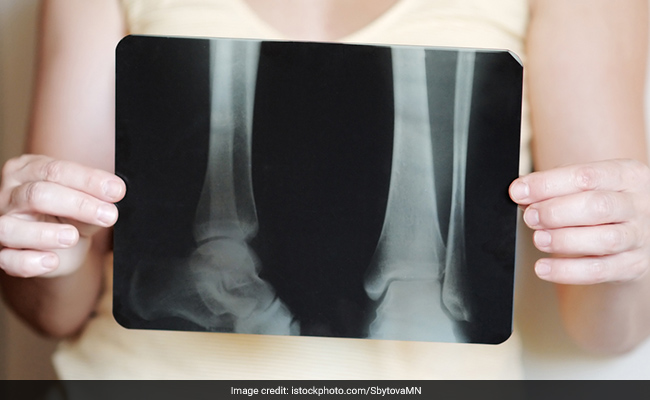 Ball Games May Boost Bone Health In School Children; 5 Foods For Stronger Bones And Muscles