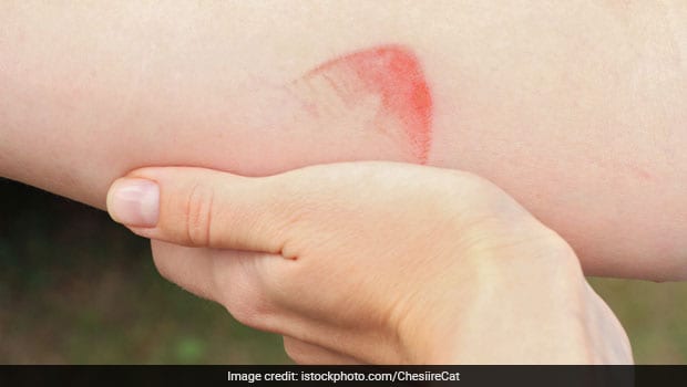 5 Effective Home Remedies For Mild Burns Ndtv Food