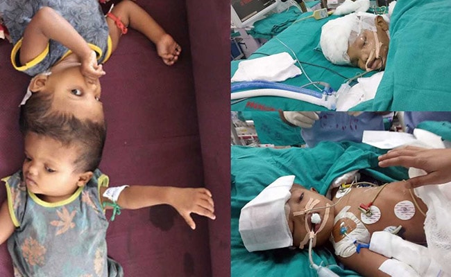सर्जरी से अलग किए गए ओडिशा के सिर से जुड़े जुड़वां बच्चों में से एक की मौत