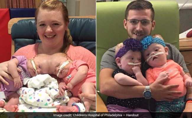 These Conjoined Twins Spent Their Lives In A Hospital. They Just Went Home - As Two.