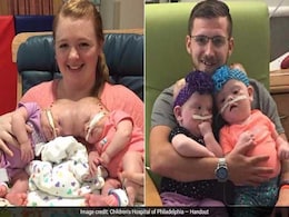 These Conjoined Twins Spent Their Lives In A Hospital. They Just Went Home - As Two. These Conjoined Twins Spent Their Lives In A Hospital. They Just Went Home - As Two.