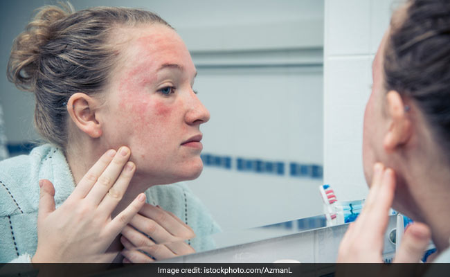 Celeb Dermatologist Recommends 4 Tips To Prevent Eczema Flare Ups During Winter