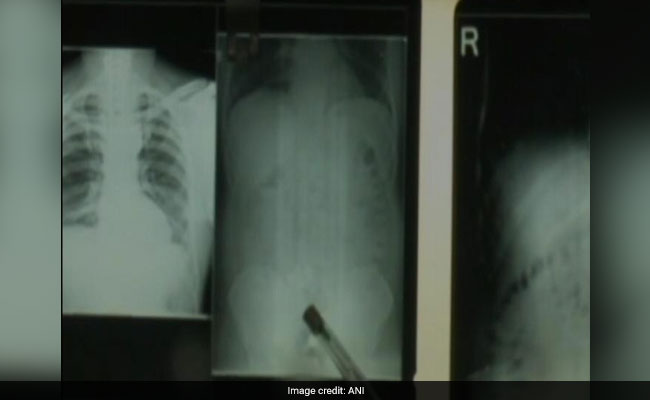 Indian Gold Smugglers Insert Metal In Rectums In Easy-To-Handle Batteries