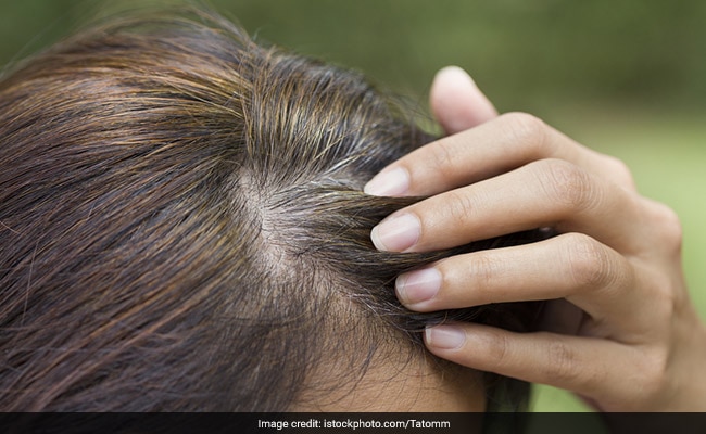 White hair Causes and ways to prevent it