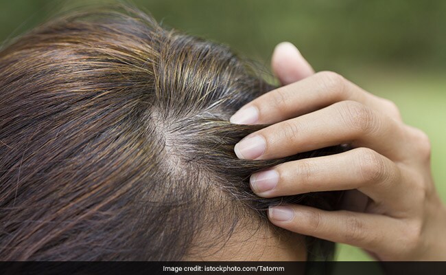 Hence Proved! Stress Can Cause Greying Of Hair