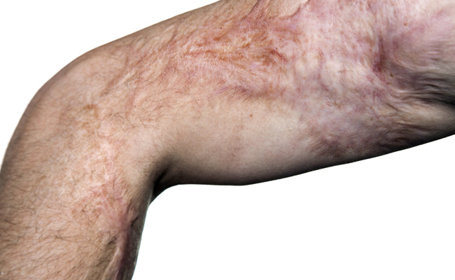 Hot Water Challenge Is The Latest Life-Taking Fad Amongst Teenagers