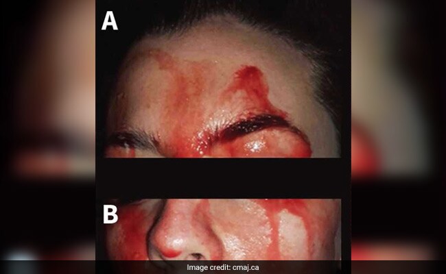 Woman Sweats Blood From Face And Palms! All You Need To Know About This Rare Disease