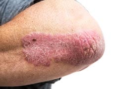 7 Foods To Avoid If You Have Psoriasis