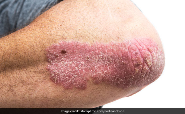 Psoriasis skin disease treatment