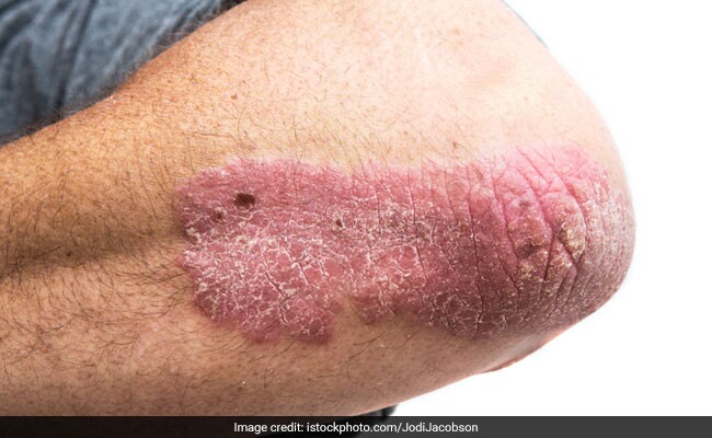 Can Ayurvedic Treatment Help Cure Psoriasis?