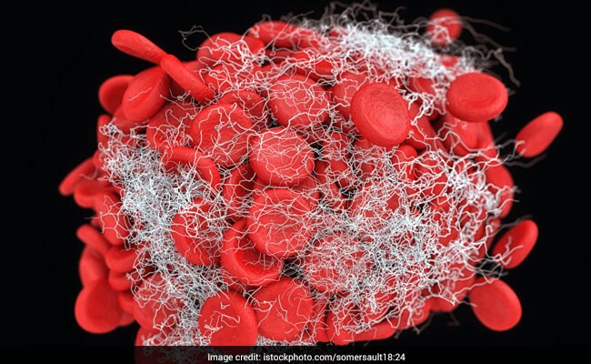 World Thrombosis Day 2024: History, Significance & Tips To Reduce Risk Of Blood Clots