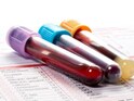 Blood Test To Spot Alzheimers Before Symptoms Occur