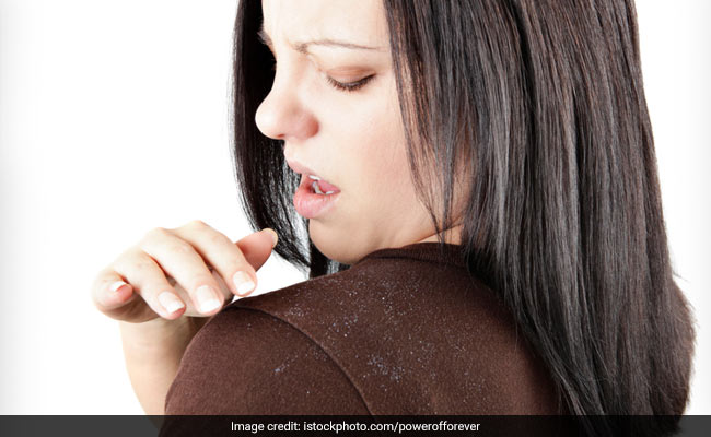 8 Easy Home Remedies To Get Rid Of Dandruff - NDTV Food