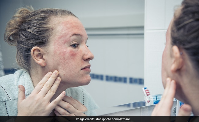 eczema is triggered because of numerous allergies
