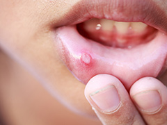 Causes Of Mouth Ulcer: पानी की कमी से ही नहीं इन 8 कारणों से भी हो जाते हैं मुंह में छाले, आज ही नोट कर लें